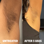 Advanced Triple-Acid Complex for Hyperpigmentation