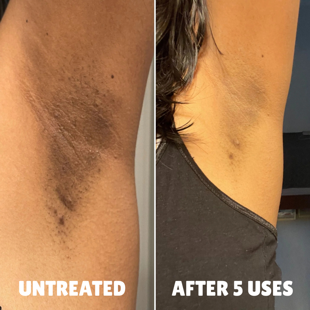 Advanced Triple-Acid Complex for Hyperpigmentation