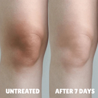 Advanced Triple-Acid Complex for Hyperpigmentation