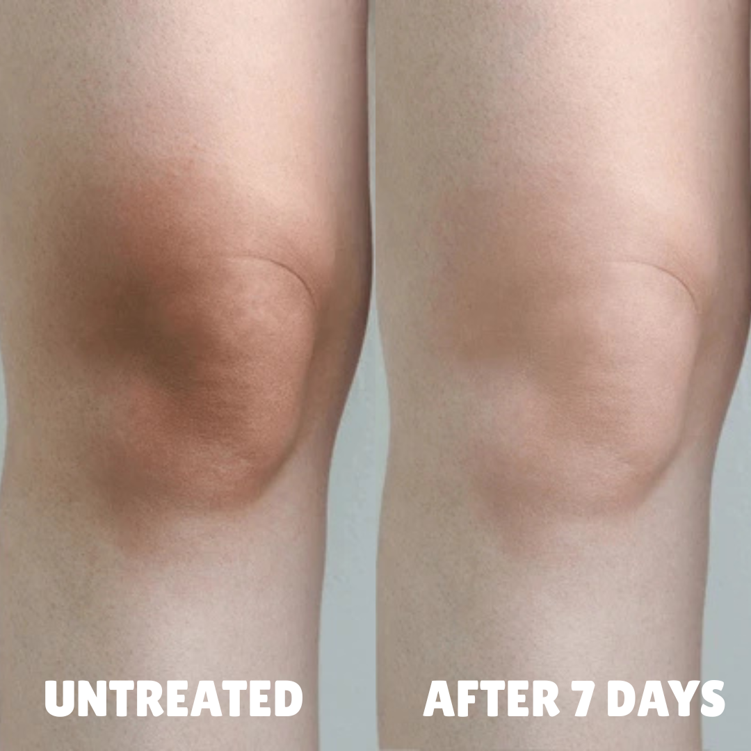 Advanced Triple-Acid Complex for Hyperpigmentation