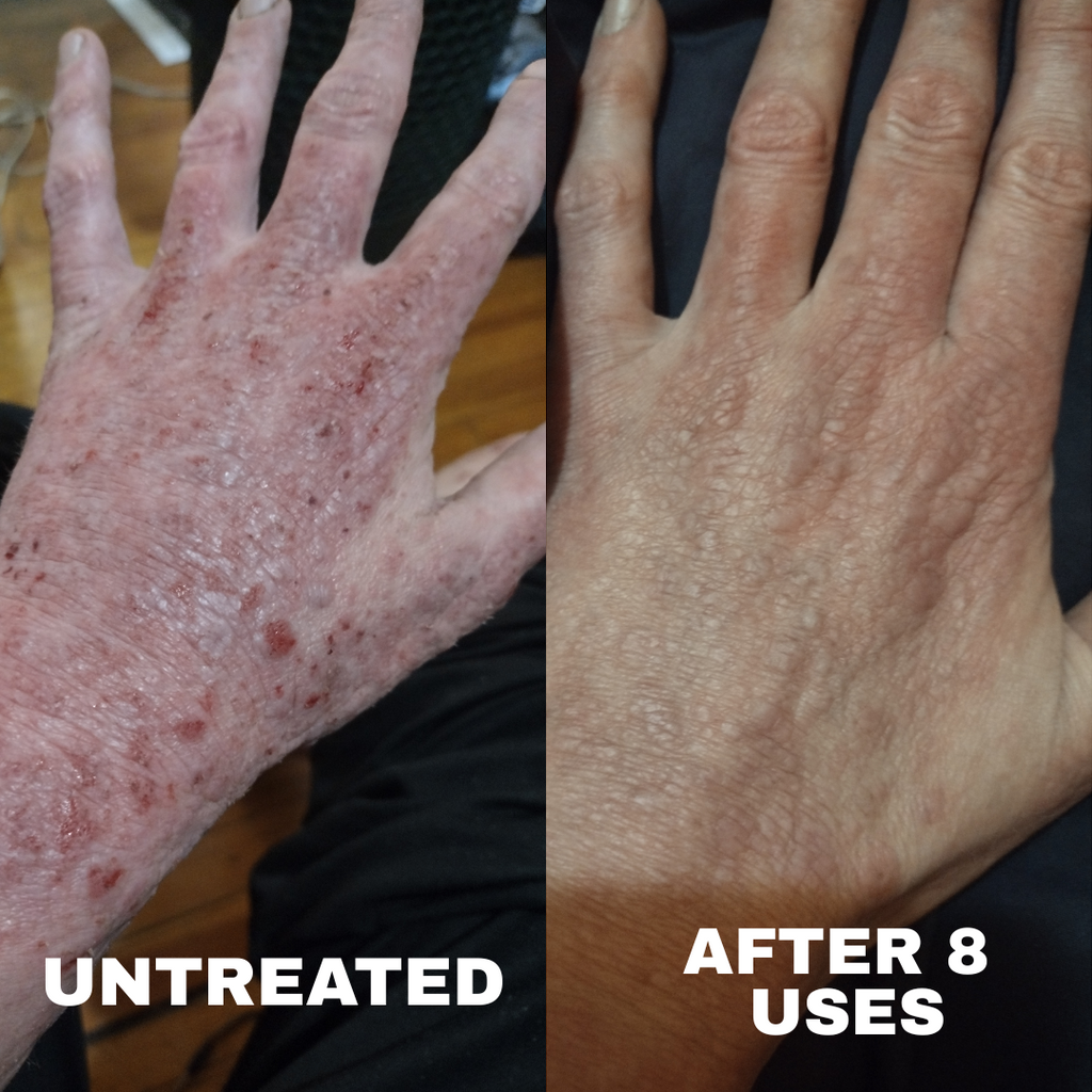 Advanced Barrier Repair Complex for Eczema