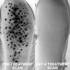 Advanced Triple-Acid Complex for Keratosis Pilaris