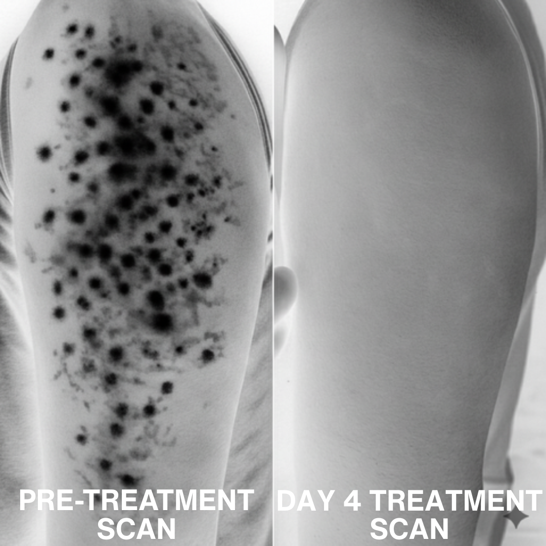 Advanced Triple-Acid Complex for Keratosis Pilaris