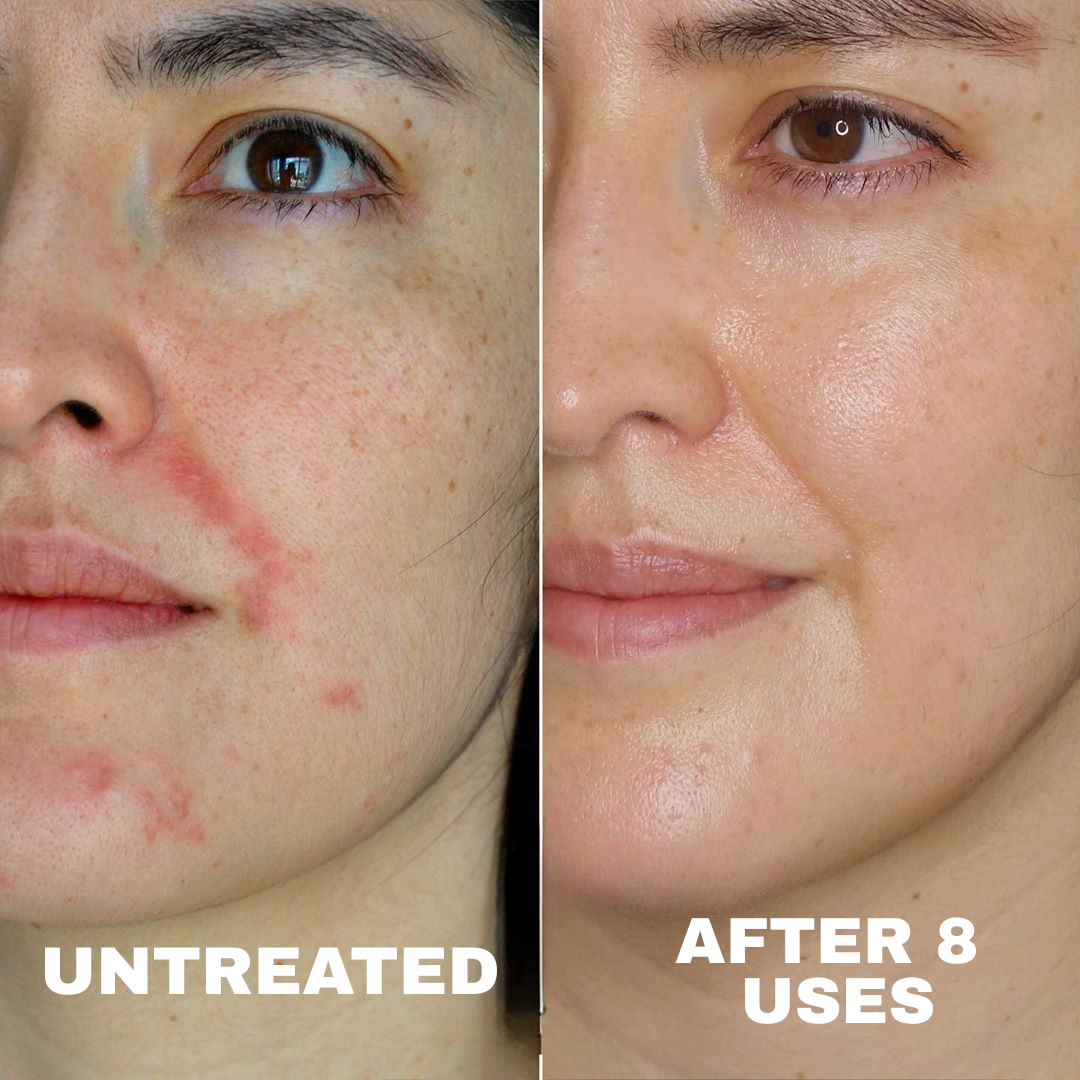 Advanced Barrier Repair Complex for Eczema