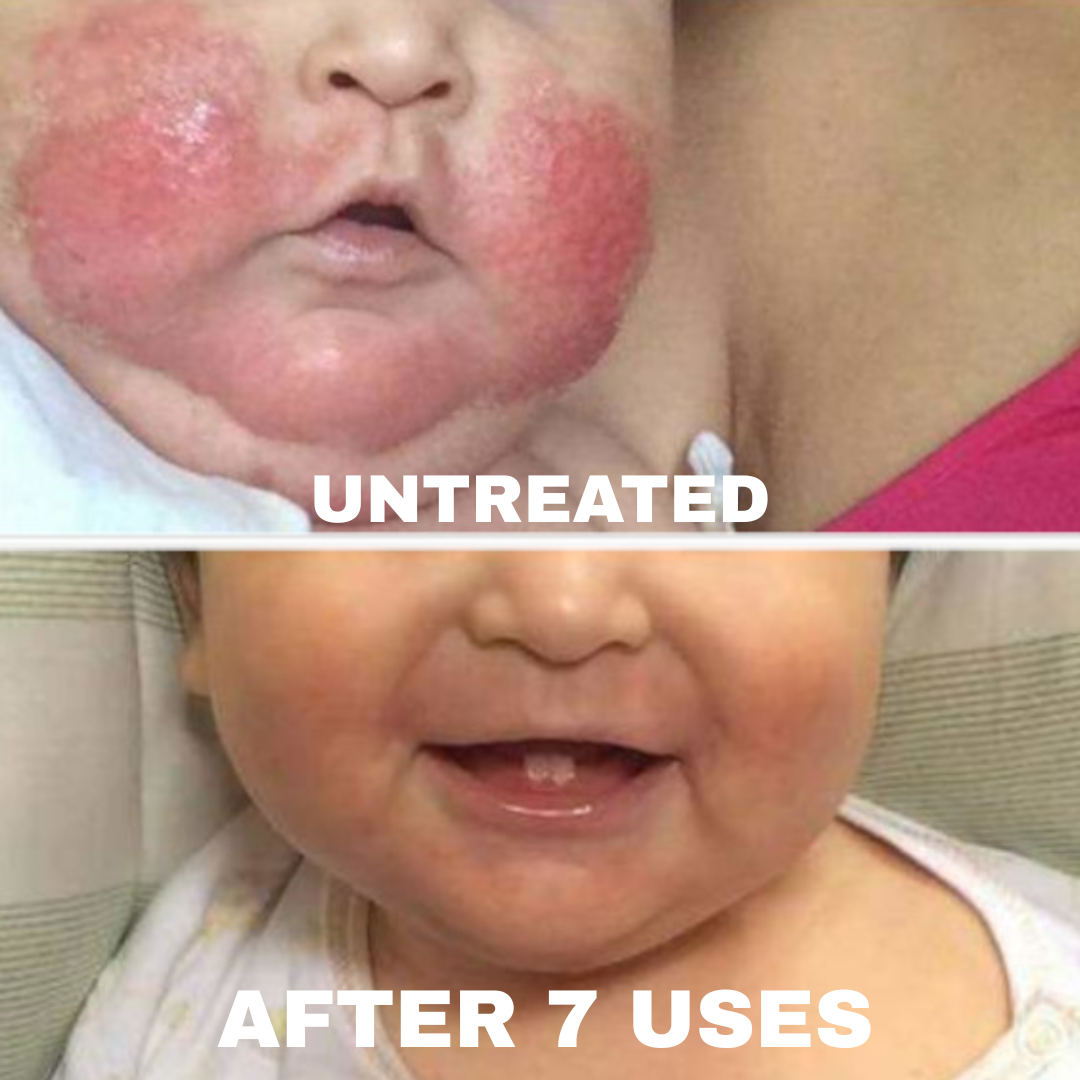 Advanced Barrier Repair Complex for Eczema