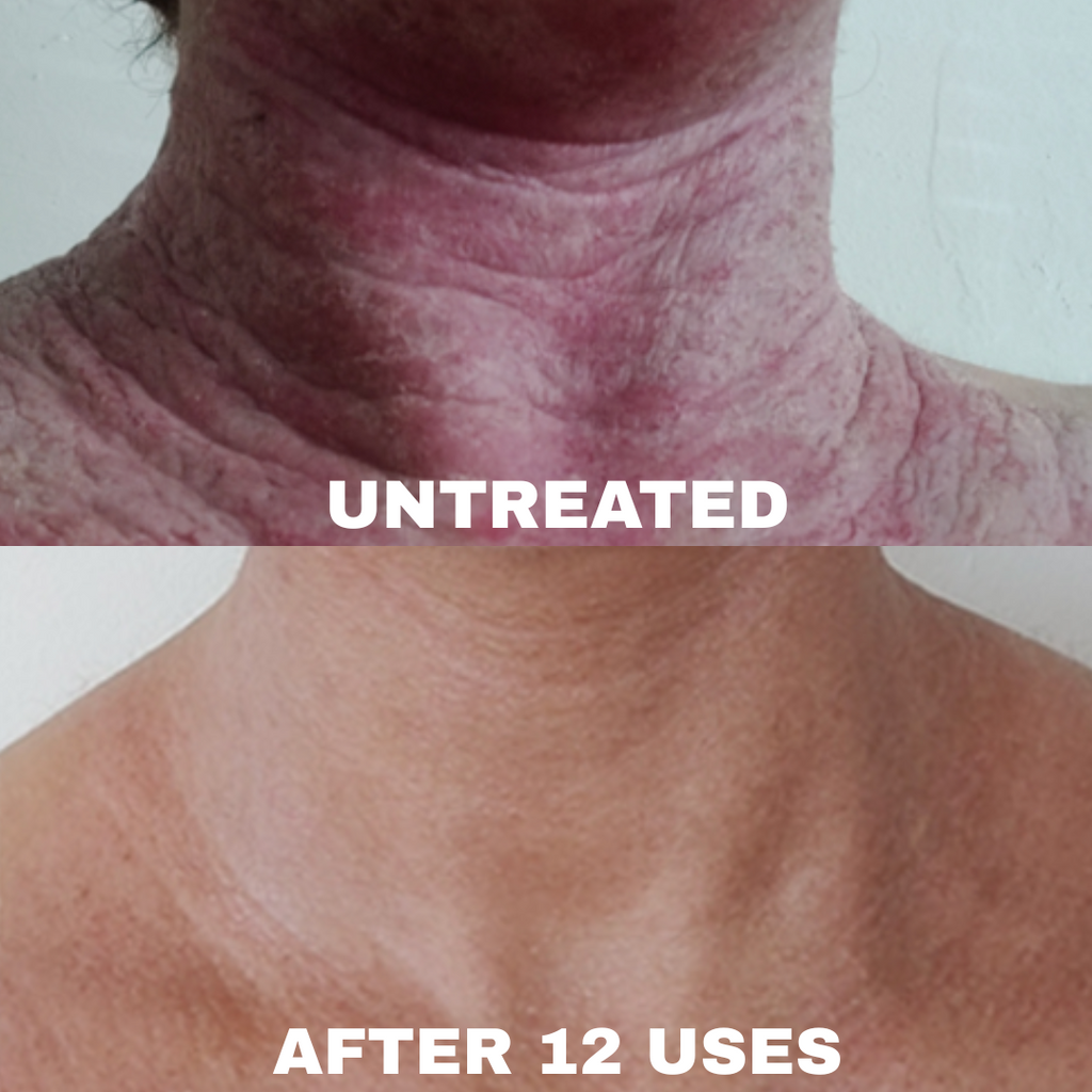 Advanced Barrier Repair Complex for Eczema