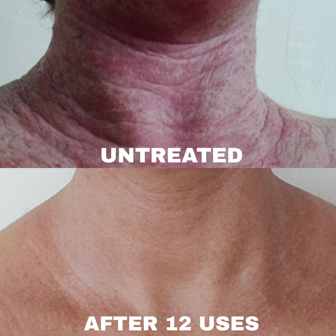 Advanced Barrier Repair Complex for Eczema