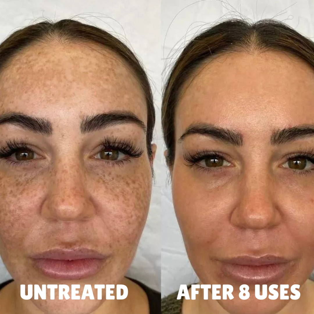 Advanced Triple-Acid Complex for Hyperpigmentation